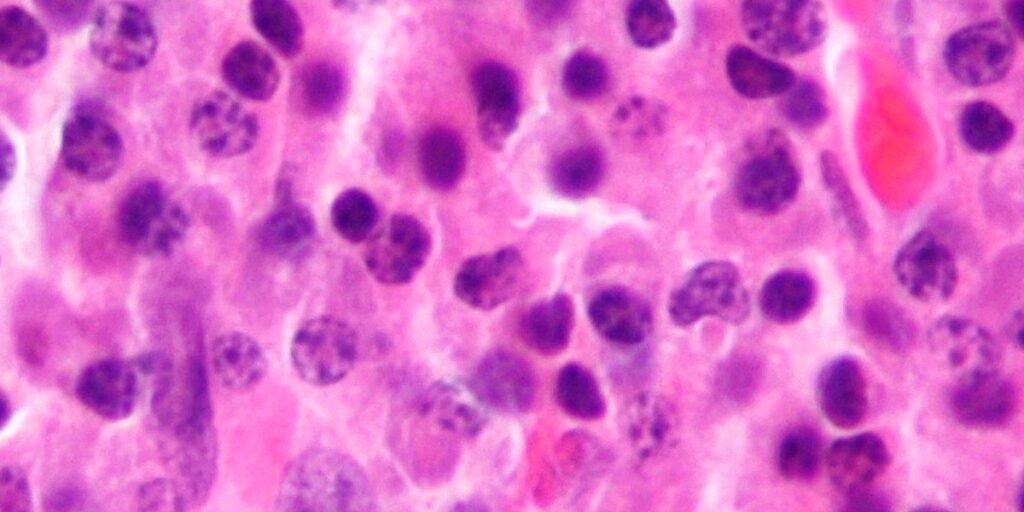 1763103969-Plasmacytoma_ultramini1.jpg