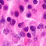 1763103969-Plasmacytoma_ultramini1.jpg