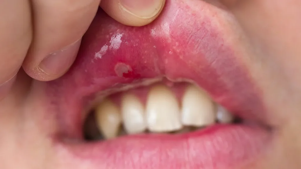 aphthe-im-mund-symbolbild-gegen-die-laestigen-blaeschen-gibt-es-einige-hausmittel-die-die-schmerzen.webp