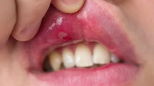 aphthe-im-mund-symbolbild-gegen-die-laestigen-blaeschen-gibt-es-einige-hausmittel-die-die-schmerzen.webp