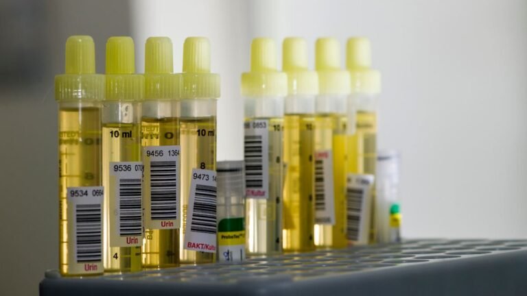 Roehrchen-mit-gelbem-Urin-gefuellt-in-einem-grauen-Gestell-sortiert-bereit-fuer-die-Diagnose.jpg