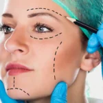 schoenheitschirurg-zeichnet-markierungen-im-gesicht-einer-patientin-eingriffe-die-das-aussehen-verbe.webp