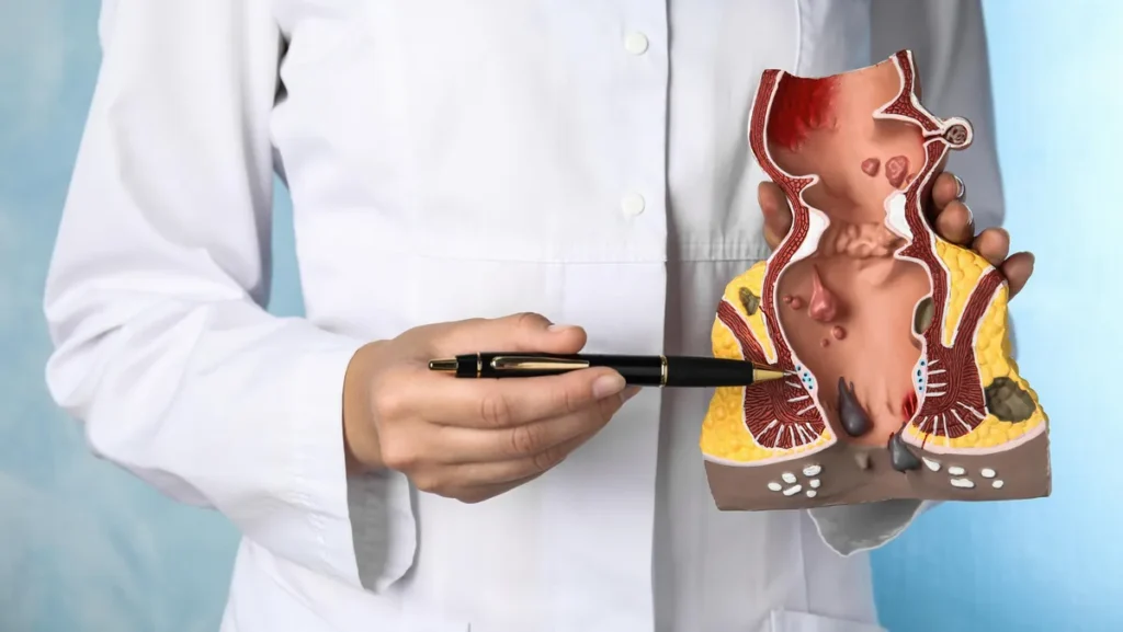 haemorrhoiden-gehoeren-zu-den-haeufigsten-analerkrankungen-jeder-mensch-besitzt-die-am-after-liegend.webp